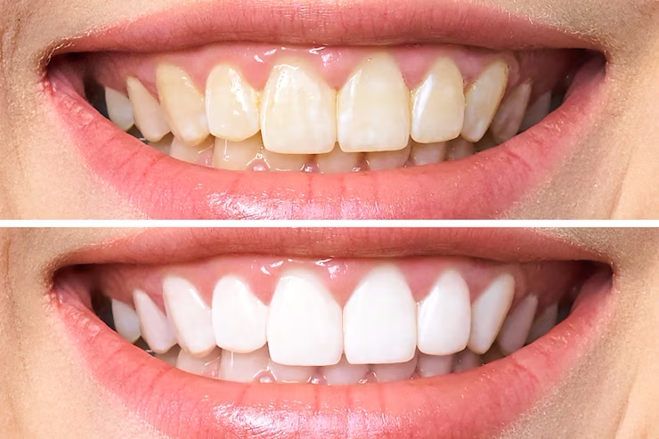 imgi_3_dentes-antes-e-depois-do-clareamento_168410-587-1