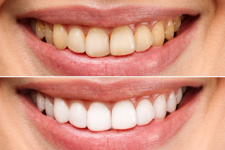 imgi_4_dentes-da-mulher-antes-e-depois-do-clareamento-sobre-fundo-branco_168410-1693-1